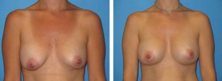 Breast augmentation case 17