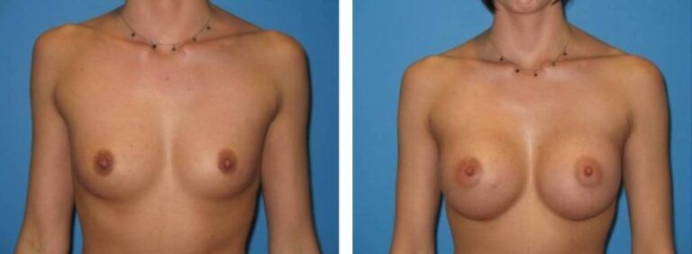 Breast augmentation case 18