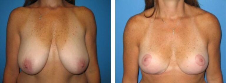 Breast augmentation case 2