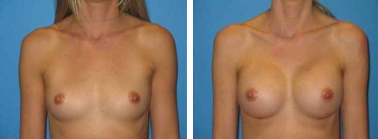 Breast augmentation case 20