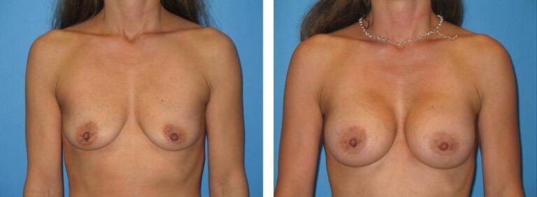 Breast augmentation case 21_1