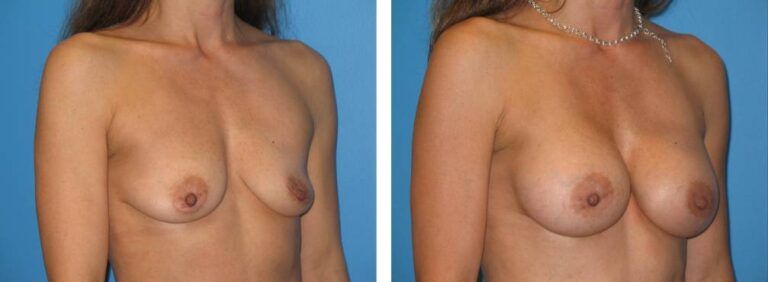 Breast augmentation case 21_2