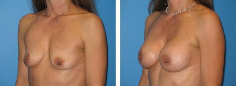 Breast augmentation case 21_3