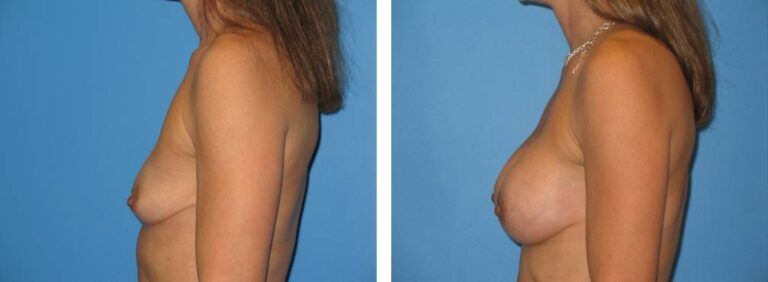 Breast augmentation case 21_4