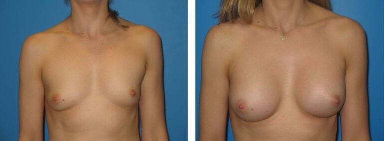 Breast augmentation case 22_1