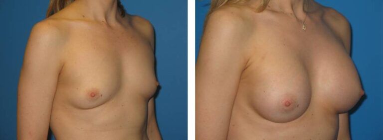Breast augmentation case 22_2