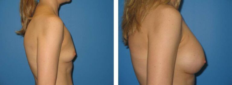 Breast augmentation case 22_3