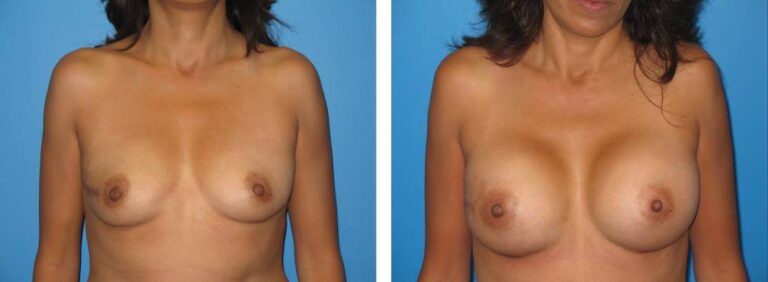 Breast augmentation case 23_1