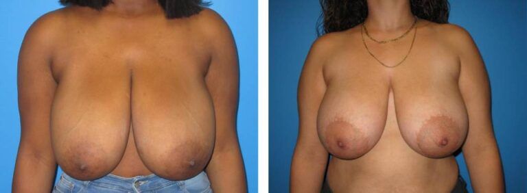 Breast augmentation case 24_1