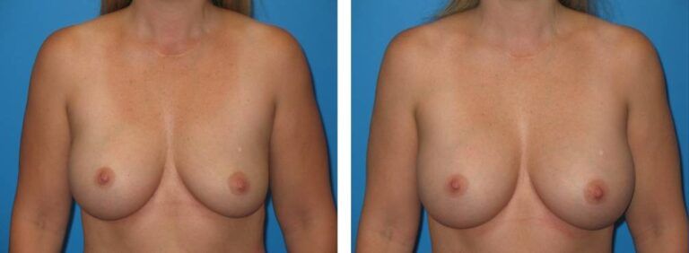 Breast augmentation case 25_1