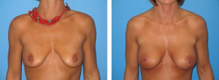 Breast augmentation case 26_1