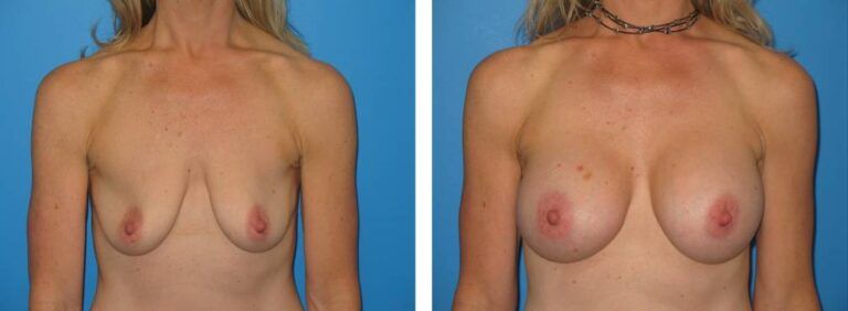 Breast augmentation case 27_1