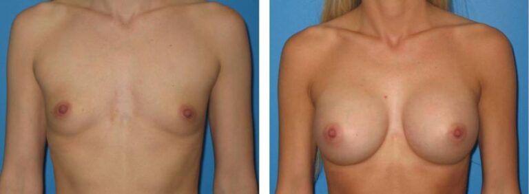 Breast augmentation case 28_1