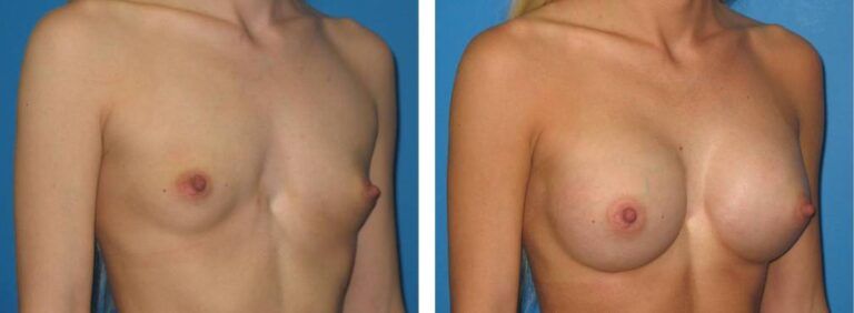 Breast augmentation case 28_2