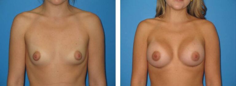 Breast augmentation case 29_1