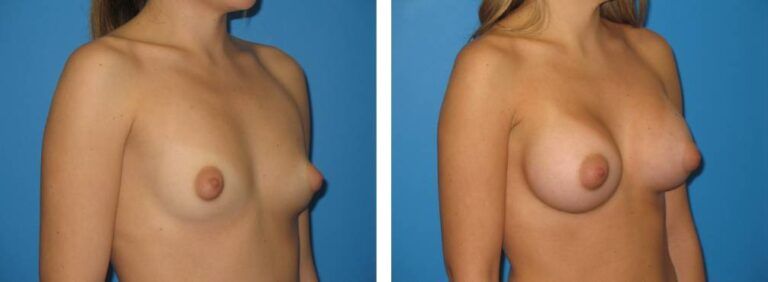 Breast augmentation case 29_2