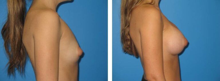 Breast augmentation case 29_3