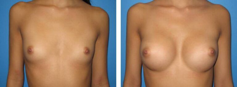 Breast augmentation case 3