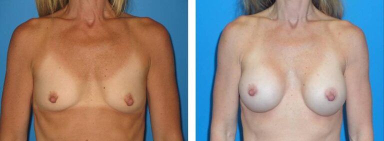 Breast augmentation case 30_1