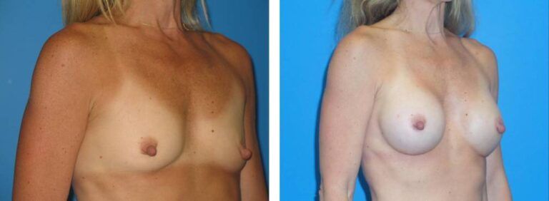 Breast augmentation case 30_2