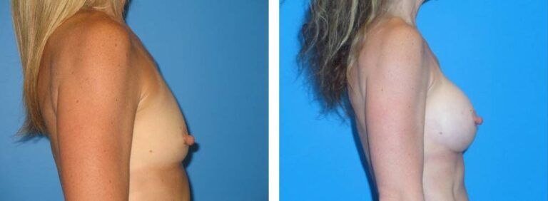Breast augmentation case 30_3