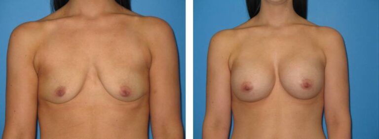 Breast augmentation case 31_1