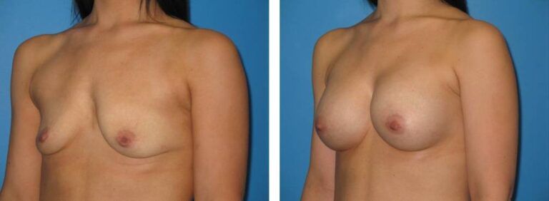 Breast augmentation case 31_2