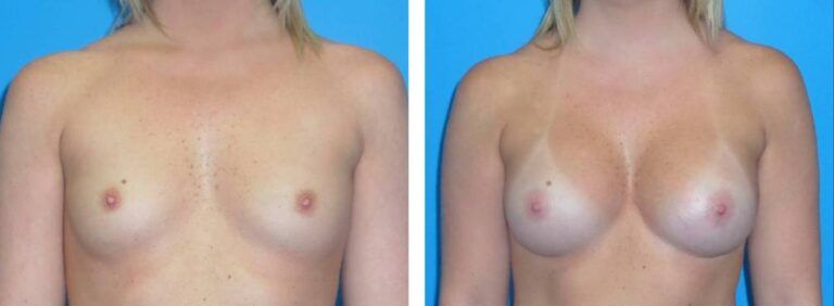 Breast augmentation case 32_1