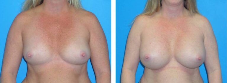 Breast augmentation case 33_1