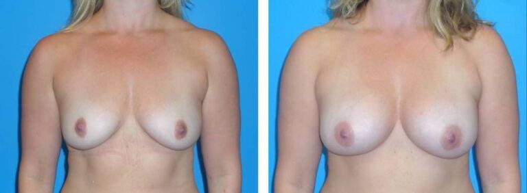 Breast augmentation case 34_1