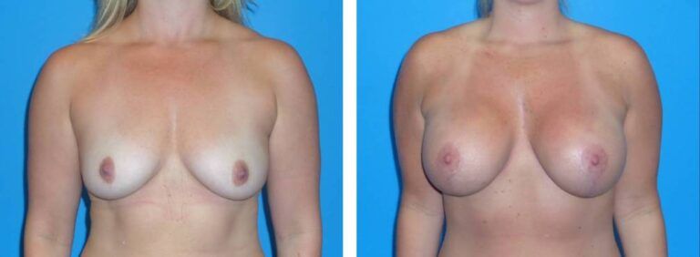 Breast augmentation case 35_1