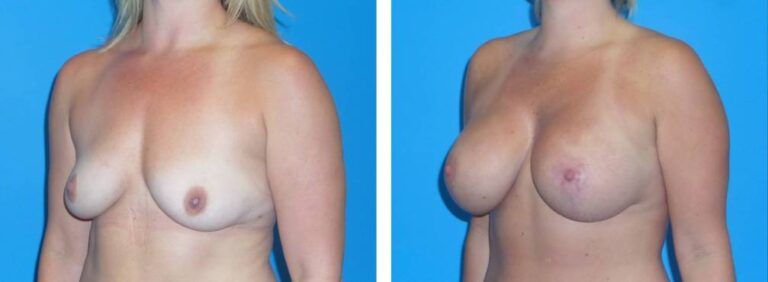 Breast augmentation case 35_2