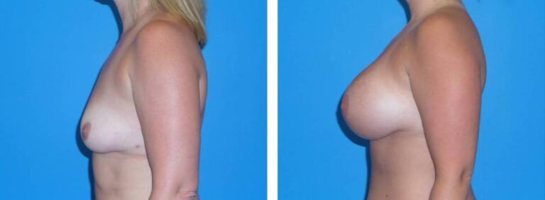 Breast augmentation case 35_3