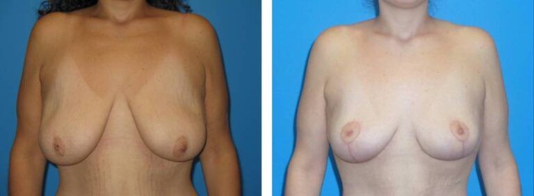 Breast augmentation case 36_1