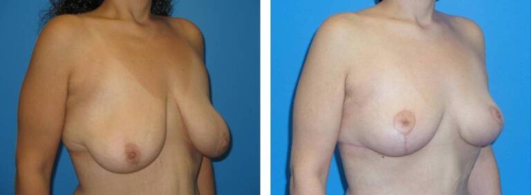 Breast augmentation case 36_2