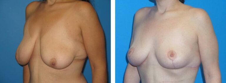 Breast augmentation case 36_3
