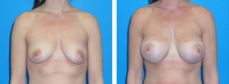 Breast augmentation case 37_1