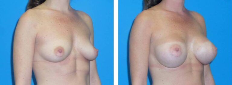 Breast augmentation case 37_2