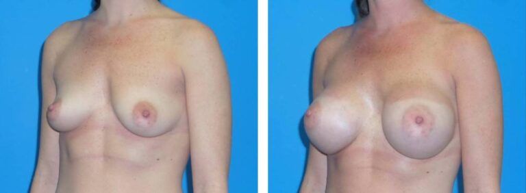 Breast augmentation case 37_3