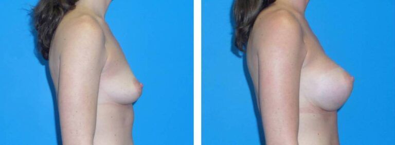 Breast augmentation case 37_4