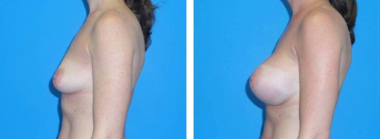 Breast augmentation case 37_5