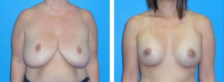 Breast augmentation case 38_1