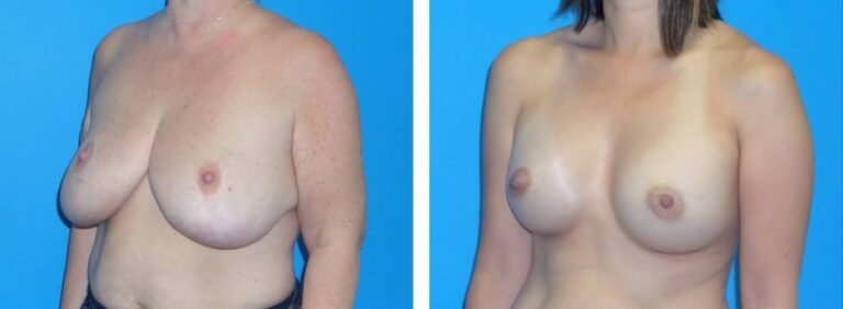 Breast augmentation case 38_2