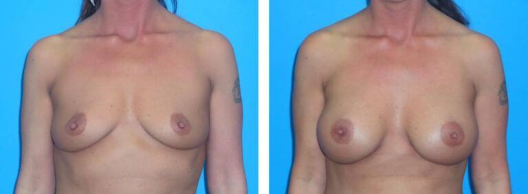 Breast augmentation case 39_1
