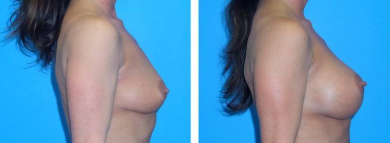 Breast augmentation case 39_2