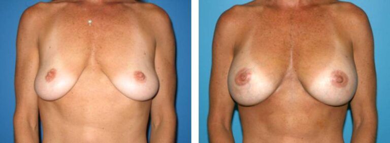 Breast augmentation case 4