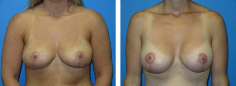 Breast augmentation case 40_1