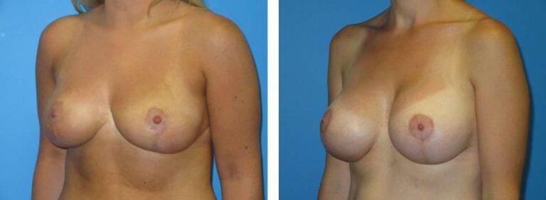 Breast augmentation case 40_2