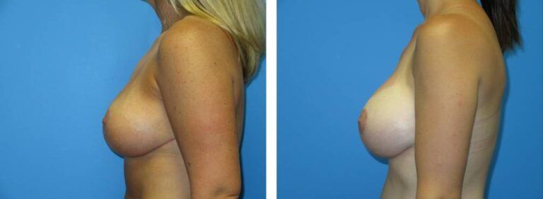 Breast augmentation case 40_3