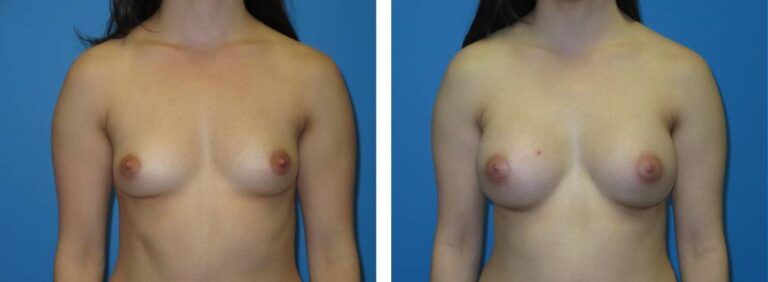Breast augmentation case 41_1